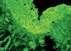 Inmunofluorescencia indirecta, empleando como substrato vejiga urinaria de rata, que revelo la presencia de anticuerpos circulantes frente a los espacios intercelulares y la membrana basal.