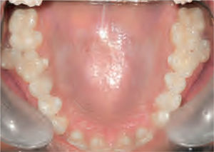 Imagen intraoral de la arcada superior en la que se observan los dientes anteriores afectados.