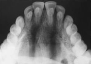 Radiografía oclusal de la línea media superior que muestra a los dientes anteriores afectados. Se observan los paramolares superiores.