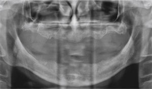 Radiografía panorámica antes de la cirugía.