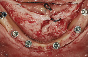 Imagen oclusal después de la colocación de los implantes.