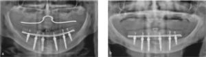 Radiografía panorámica después de la cirugía (a) y 3 años después de la cirugía (b).