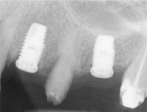 Situación después de la extracción del primer premolar y de la colocación de dos implantes en la región del primer premolar y del primer molar.