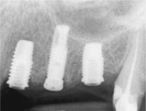 Situación después de la extracción del segundo premolar y de la colocación de un tercer implante. Sospecha de perforación del seno maxilar.