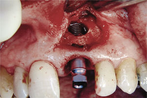 Imagen intraoperatoria. Acceso submarginal y enucleación de la lesión periapical seguida de la colocación de un implante inmediato.
