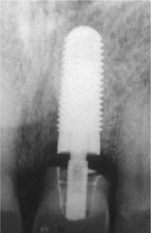 Control radiográfico postoperatorio del implante y de la restauración provisional.