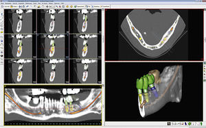 Captura de pantalla de SimPlant Crystal, uno de los programas más «veteranos» de planificación de implantes.