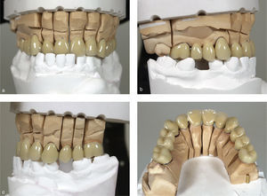 Provisionales de larga duración en el modelo. Vista anterior (a), lateral derecha (b), lateral izquierda (c) y oclusal (d).