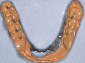 Registro de la posición intermaxilar en la férula oclusal.