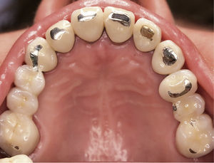 Vista oclusal de la arcada superior al inicio del tratamiento. Son claramente visibles las señales dejadas por el tallado selectivo practicado por el primer terapeuta. La envergadura del tallado selectivo queda patente especialmente en los dientes anterosuperiores, en los que las restauraciones fueron rebajadas por completo hasta llegar a la dentina.