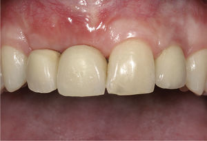Imagen de la prótesis provisional colocada con la base rebajada 3 meses después del segundo aumento.