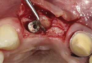 Exposición del implante 12 con desplazamien-to del tejido blando supraimplantario hacia la papila 11/12.