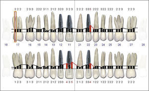 Situación periodontal inicial de la arcada superior.