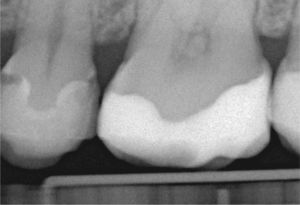 Radiografía de aleta de mordida realizada du-rante una revisión a los seis meses de haber realizado la restauración. Llama la atención el déficit de tejido denta-rio en las cajas proximales del premolar 15 adyacente al diente 16 tratado con anterioridad.