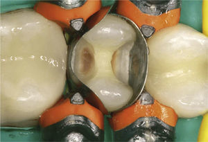 Aspecto del diente con la cavidad preparada y provisto del anillo 3D.