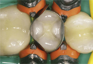 Utilización del composite fluido blanco opaco Venus Diamond Flow Baseliner para marcar el suelo de la cavidad.