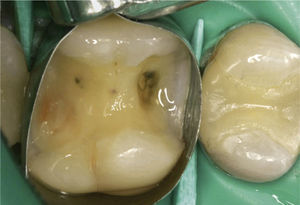 Indicación de tratamiento en un diente con in fracturado.