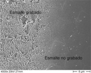 Esmalte grabado y no gra. Imagen de microscopía elec de barrido a 4.000 aumentos.