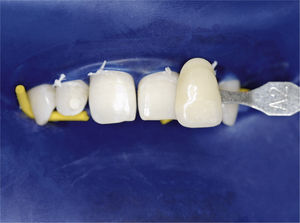 Aclaramiento del color dental mediante el se-cado: el color A2 corresponde al color de los dientes en estado húmedo. Después del secado de los dientes du algunos minutos (en este caso con dique de goma), los dientes tienen un aspecto claramente más pálido.