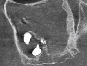 Tomografía volumétrica digital dental: plano sa-gital. Además de los depósitos de densidad metálica se observa también un ensanchamiento manifiesto de la pa-red dorsal del seno maxilar. Esta alteración es fruto de una sinusitis crónica de larga evolución (años).