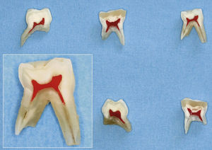 Molares temporales seccionados en sentido mesiodistal que ilustran las re-laciones dimensionales de la obturación, de las porciones de esmalte y dentina y de la cámara pulpar (en rojo).