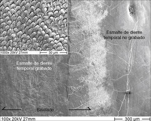 Esmalte grabado y sin grabar de un diente tem-poral con biselado previo. Imagen de microscopía elec-trónica de barrido, 100 y 1.000 aumentos.