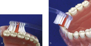 Técnica de cepillado circular de Fones. a) La limpieza de la cara externa se lleva a cabo con el cepillo en un ángulo de 90° y pequeños movimientos circulares sobre encías y dientes. De esta for las cerdas penetran en los espacios interdentales. b) La limpieza de la cara interna se realiza con el cepillo lo más vertical posi y movimientos en zig-zag en sentido mesial y distal.