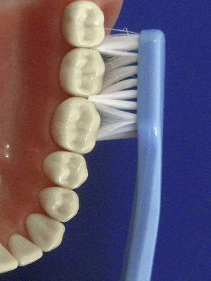 Técnica de Bass: la limpieza de las caras interna y externa se lleva a cabo con el cepillo en un ángulo de 45° y movimientos vibratorios seguidos de movimientos de barrido hacia la corona dentaria.