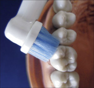 Los cepillos con acción ro de cerdas para la profilaxis SOLO.tatoria/oscilante se colocan en un án de 90° y se dirigen sobre los dientes y los espacios interdentales con un movimiento de balanceo.