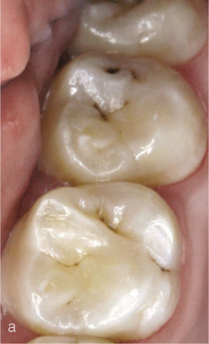 Fotografía oclusal de los dientes 16 y 17 tras la limpieza dental. En la fosa distal del diente 17 existe la sospecha de existencia de una lesión dentinaria.