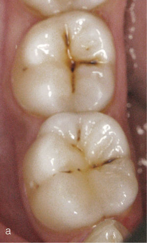 Fotografía oclusal del diente 47 con fisura tincionada.