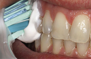 Los aditivos activos en pastas dentífricas ayu- dan a muchos pacientes a mitigar la sensibilidad al do- lor. Las más recientes innovaciones, como la tecnología Pro-Argin, manifiestan su efecto en un tiempo muy bre- ve. Los productos convencionales (con contenido en sa- les de potasio) requieren unas dos semanas de aplica- ción para reducir las sensibilidades.