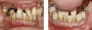 Situación intraoral de la paciente. Se observó un estado desolado de la dentición, con una higiene oral insuficiente y halitosis pronunciada.