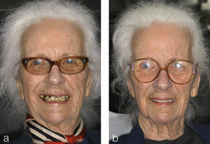 Fotografías frontales de la paciente antes y después de la conclusión del tratamiento y de la rehabilitación protésica de los maxilares superior e inferior conforme al concepto de la prótesis ampliable.