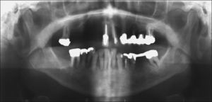 Ortopantomografía de la paciente. Además de la reabsorción ósea horizontal y vertical, se diagnosticó una perforación iatrógena del diente 34.