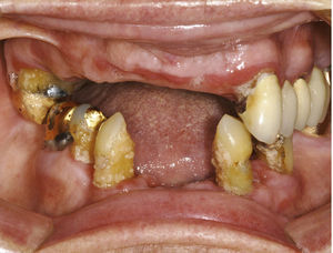 Situación intraoral tras la extracción de los dientes 11 y 21 así como 42 hasta 32.