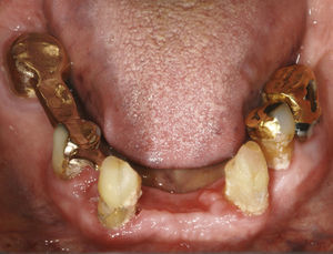 Vista de la dentición en el maxilar inferior tras la extracción de los incisivos y del diente 34.