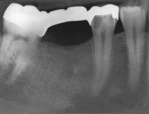 Imagen preoperatoria del diente 45 con una caries que se extiende hasta las proximidades de la pulpa. Se llevó a cabo una endodoncia (extraído de Georgi y Hülsmann21).
