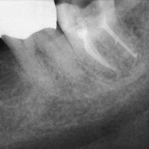 Paciente VIH positivo: radiografía de control tras la obturación de los conductos radiculares en el diente 37, el cual estaba asociado a una periodontitis apical.