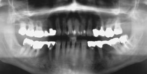 La radiografía de control al cabo de 3,5 años permite apreciar una regeneración ósea completa en el diente 37. La periodontitis apical en el diente 46 requirió una revisión ortógrada del tratamiento de los conductos radiculares.
