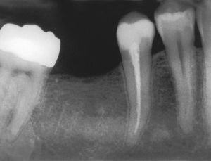 Radiografía de control una vez concluida la endodoncia (extraído de Georgi y Hülsmann21).