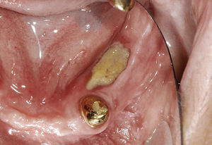 Ulceraciones gingivales linguales y necrosis por bifosfonatos del hueso.