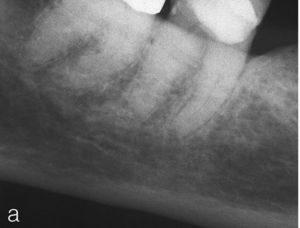 Imagen preoperatoria del diente 47 de una paciente durante el tratamiento con bifosfonatos.