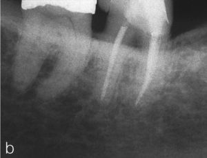 El control a los 3 años muestra una situación perirradicular normal. También la endodoncia discurrió sin problemas. El diente todavía está provisto de una restauración adhesiva.