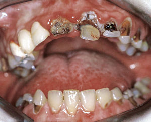 Estado clínico tras la radioterapia. La acusada destrucción dentaria con exposición de la pulpa requiere tratamientos de conductos radiculares en varios dientes.