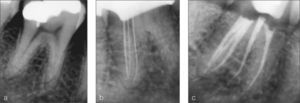 Primer molar inferior con cinco conductos, dos mesiales y tres distales. (a) Radiografía preoperatoria que muestra la bifurcación del tercio apical de la raíz mesial. (b) Radiografía de conductometría de la raíz distal. (c) Radiografía postoperatoria (mesioangulada).