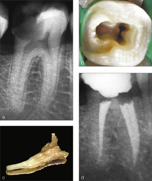 Primer molar inferior con un conducto mesial. (a) Radiografía preoperatoria. (b) Acceso al conducto único de la raíz mesial. (c)Tejido pulpar extraído del conducto mesial. (d) Radiografía postoperatoria.