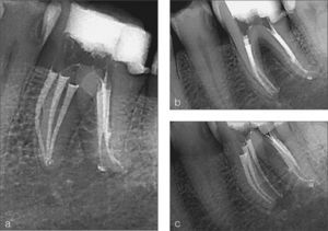 Primer molar inferior con seis conductos. Cortesía del Dr. Freddy Belliard, Guadalajara, España.