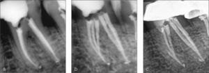 Primer molar inferior con cinco conductos, tres mesiales y dos distales. (a) Radiografía postoperatoria (ortoangulada). (b) Radiografía postoperatoria (mesioangulada). (c) Radiografía de seguimiento 2 años después del tratamiento. Se observa que se ha colocado un poste en uno de los conductos radiculares mesiales.