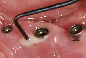 Las dolencias periimplantarias constituyen uno de los mayores retos futuros en la terapia odontológica.